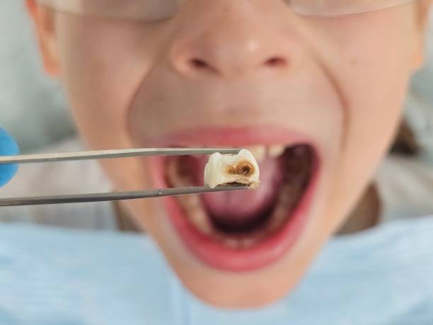 Best Emergency Tooth Extraction in Four Cners, OR